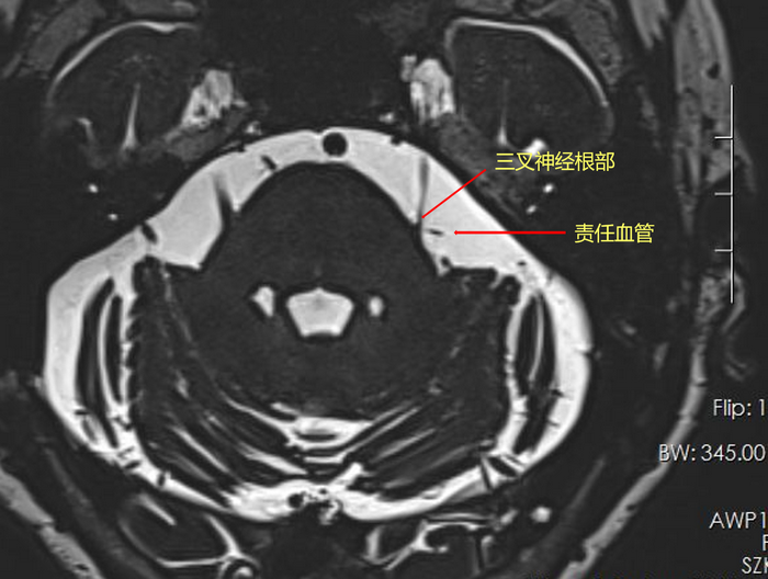 六旬患者飽受三叉神經(jīng)痛折磨 微血管減壓術(shù)“一招止痛”_1.png