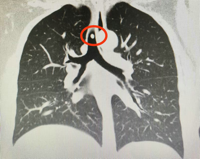 女子反復咳嗽半年之久 硬質(zhì)氣管鏡揪出“真兇”_1.jpg